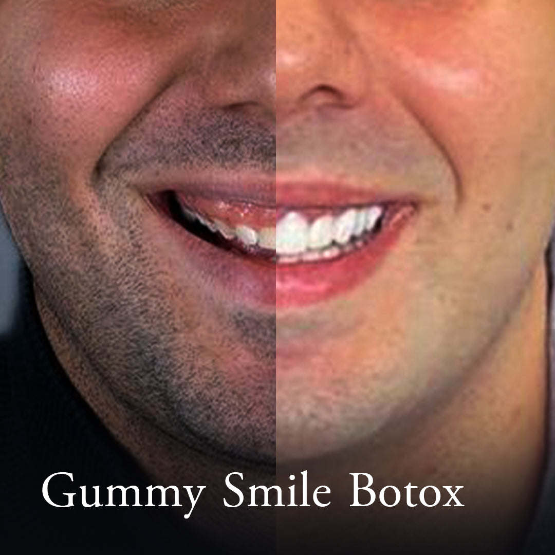Botox for Gummy Smile