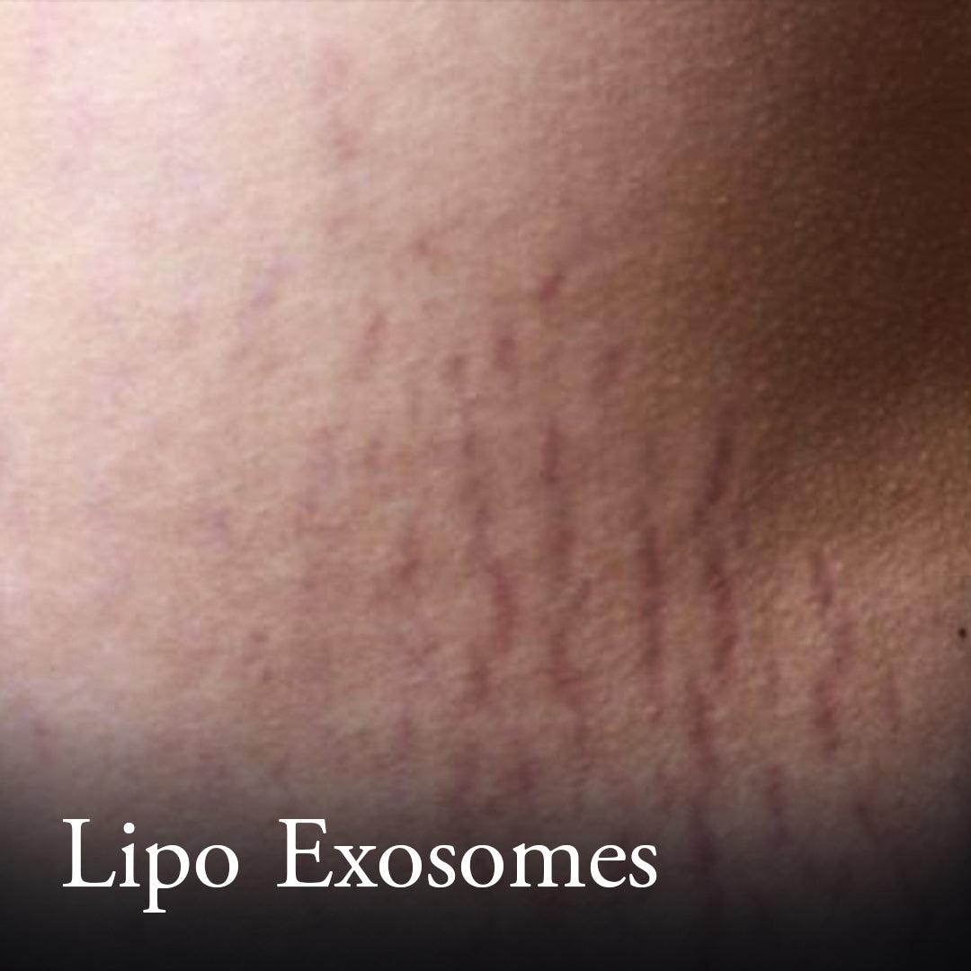Lipo-Exosomes