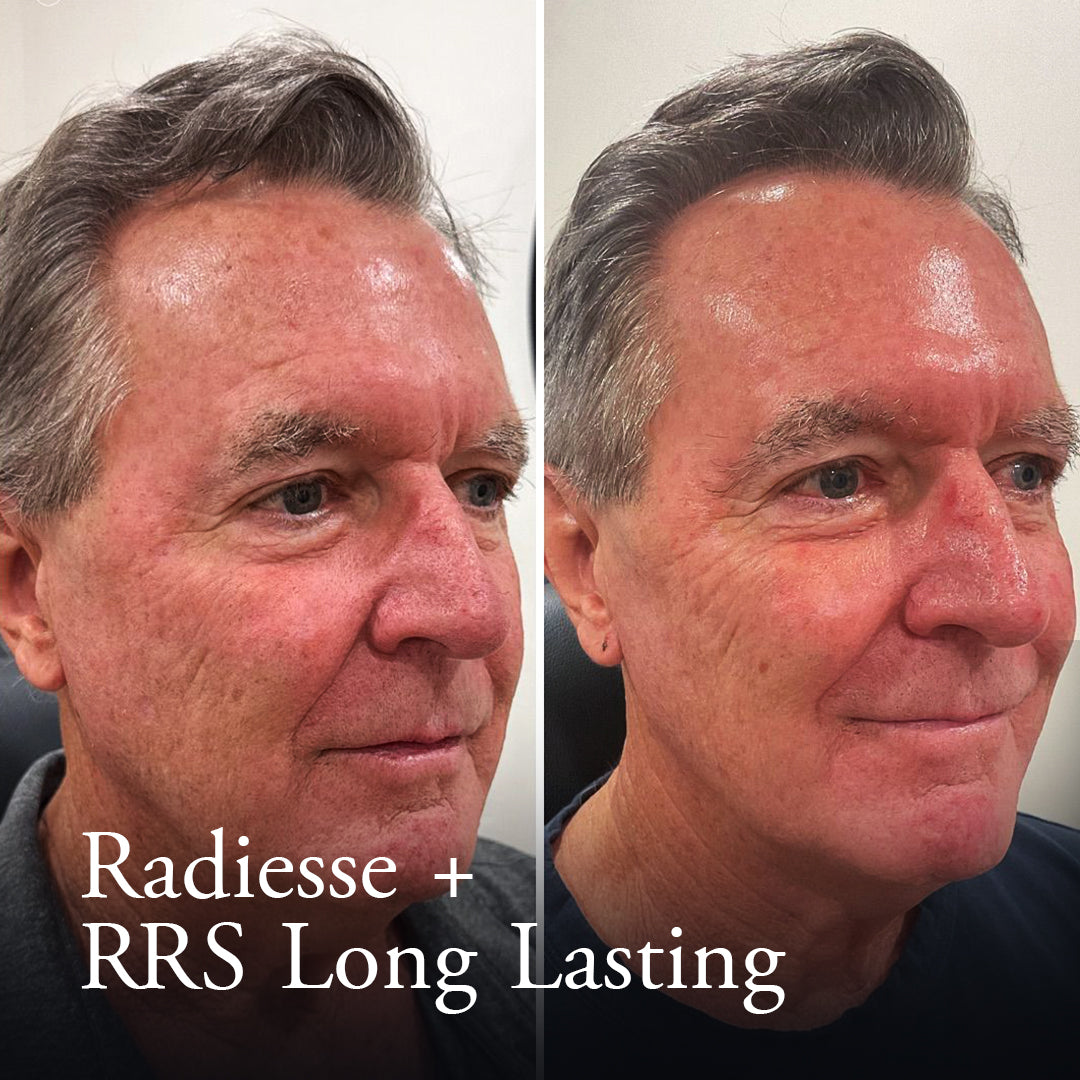Radiesse + RRS (Long-Lasting)