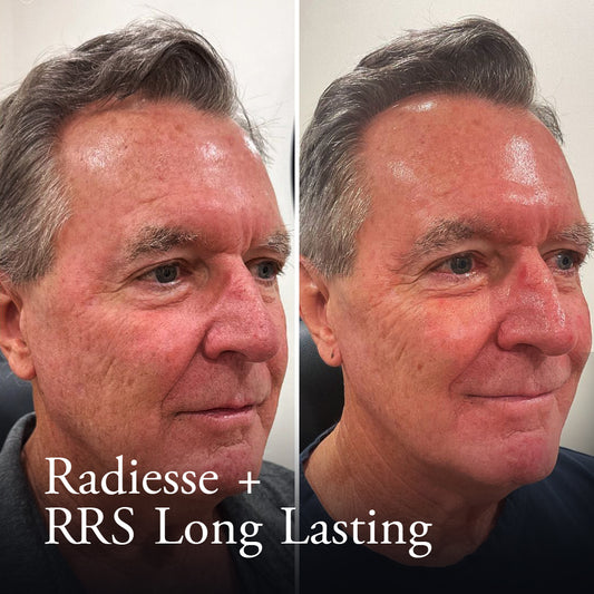 Radiesse + RRS (Long-Lasting)